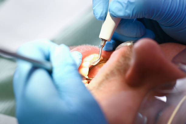 Best Emergency Tooth Extraction in Winchester, KY